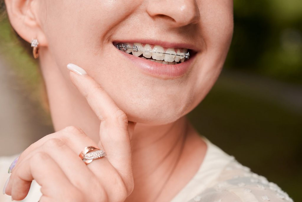 sonrisa en primer plano con ortodoncia normal